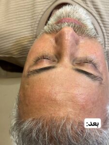 نمونه کار پاکسازی صورت آقایان