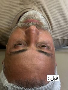 نمونه کار پاکسازی صورت آقایان