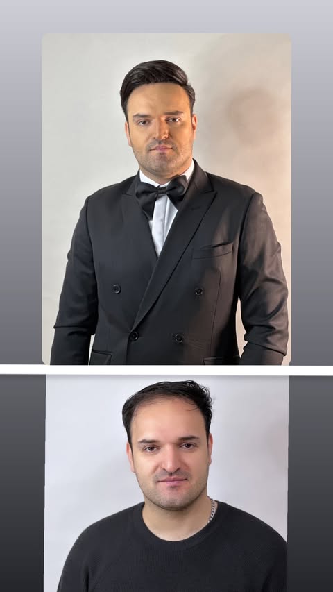 کاشت موی موقت داماد